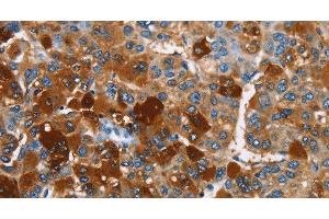 Immunohistochemistry of paraffin-embedded Human liver cancer using ARMCX2 Polyclonal Antibody at dilution of 1:40 (ARMCX2 antibody)