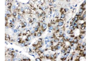 Catalase was detected in paraffin-embedded sections of human liver cancer tissues using rabbit anti- Catalase Antigen Affinity purified polyclonal antibody (Catalog # ) at 1 µg/mL. (Catalase antibody  (AA 344-527))