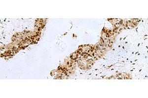 Immunohistochemistry of paraffin-embedded Human breast cancer tissue using H2AFJ Polyclonal Antibody at dilution of 1:170(x200) (H2AFJ antibody)