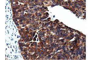 Immunohistochemical staining of paraffin-embedded Adenocarcinoma of Human colon tissue using anti-CBWD1 mouse monoclonal antibody. (CBWD1 antibody)