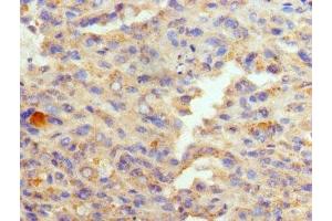 Immunohistochemistry of paraffin-embedded human melanoma using ABIN7152009 at dilution of 1:100 (GATA1 antibody  (AA 39-153))