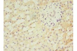 Immunohistochemistry of paraffin-embedded human liver cancer using ABIN7144167 at dilution of 1:100 (ANKMY2 antibody  (AA 1-280))