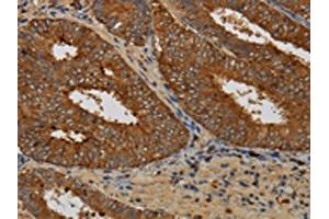 The image on the left is immunohistochemistry of paraffin-embedded Human colon cancer tissue using ABIN7129963(KCNK17 Antibody) at dilution 1/60, on the right is treated with fusion protein. (KCNK17 antibody)