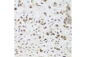 Immunohistochemistry of paraffin-embedded human gastric cancer using PPP1CC antibody (ABIN5972199) at dilution of 1/100 (40x lens). (PPP1CC antibody)