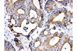 Anti- IDH2 Picoband antibody, IHC(P) IHC(P): Human Intestinal Cancer Tissue (IDH2 antibody  (C-Term))