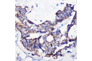 Immunohistochemistry of paraffin-embedded Human colon carcinoma using  Rabbit pAb (ABIN7265426) at dilution of 1:100 (40x lens). (ACSS1 antibody  (AA 340-689))