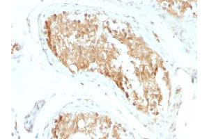Formalin-fixed, paraffin-embedded human Testicular Carcinoma stained with ALDH1A1 Mouse Monoclonal Antibody (ALDH1A1/1381). (ALDH1A1 antibody  (AA 315-434))