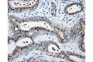 Immunohistochemical staining of paraffin-embedded Adenocarcinoma of colon tissue using anti-VAT1L mouse monoclonal antibody. (VAT1L antibody)