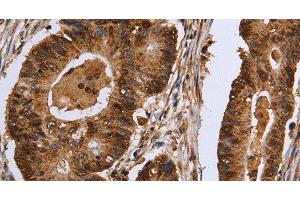 Immunohistochemistry of paraffin-embedded Human colon cancer tissue using EXTL3 Polyclonal Antibody at dilution 1:30 (EXTL3 antibody)