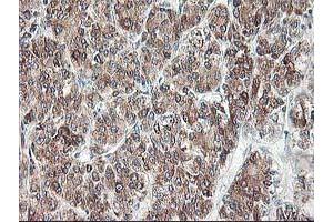 Immunohistochemical staining of paraffin-embedded Carcinoma of Human liver tissue using anti-RPN1 mouse monoclonal antibody. (RPN1 antibody)
