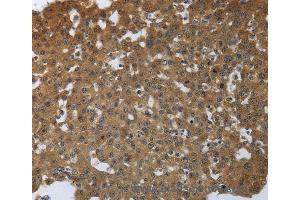 Immunohistochemistry of Human lung cancer using PTPRM Polyclonal Antibody at dilution of 1:40