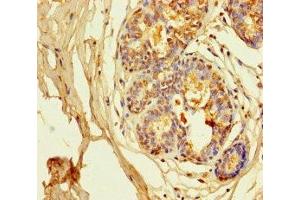 Immunohistochemistry of paraffin-embedded human breast cancer using ABIN7163953 at dilution of 1:100
