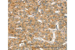 Immunohistochemistry of Human esophagus cancer using RASSF9 Polyclonal Antibody at dilution of 1:45