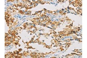 The image on the left is immunohistochemistry of paraffin-embedded Human thyroid cancer tissue using ABIN7129804(IDH3B Antibody) at dilution 1/30, on the right is treated with fusion protein. (IDH3B antibody)