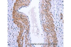 Immunohistochemistry of Human cervical cancer using GPR171 Polyclonal Antibody at dilution of 1:25 (GPR171 antibody)