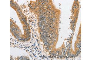 Immunohistochemistry of Human liver cancer using ARHGAP5 Polyclonal Antibody at dilution of 1:30