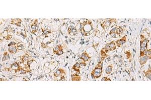 Immunohistochemistry of paraffin-embedded Human liver cancer tissue using MMAB Polyclonal Antibody at dilution of 1:65(x200)