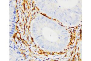 Anti-Galectin 1 antibody, IHC(P) IHC(P): Human Intestinal Cancer Tissue (LGALS1/Galectin 1 antibody  (C-Term))