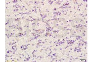 Formalin-fixed and paraffin embedded human glioma labeled with Anti-CHRNA4 Polyclonal Antibody, Unconjugated (ABIN736746) at 1:200 followed by conjugation to the secondary antibody and DAB staining. (CHRNA4 antibody  (AA 531-627))