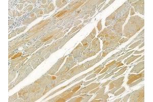 ABIN6260380 and ABIN6276612 at 1/100 staining human tongue carcinoma by IHC-P. (CA3 antibody  (N-Term))