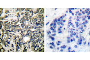P-peptide - +Immunohistochemical analysis of paraffin-embedded human breast carcinoma tissue using 14-3-3 ζ (phospho-Ser58) antibody.