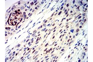 Immunohistochemical analysis of paraffin-embedded esophageal cancer tissues using TFAP2C mouse mAb with DAB staining. (TFAP2C antibody  (AA 341-450))