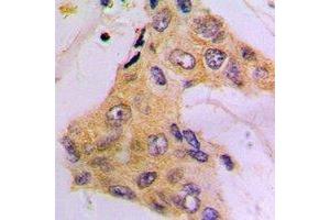 Immunohistochemical analysis of Beta-tubulin-HRP labled staining in human breast cancer formalin fixed paraffin embedded tissue section. (TUBB antibody  (HRP))