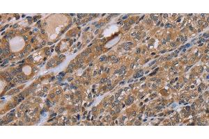 Immunohistochemistry of paraffin-embedded Human thyroid cancer tissue using NAA25 Polyclonal Antibody at dilution 1:40 (NAA25 antibody)