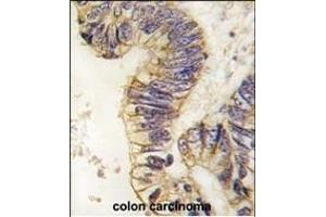 Formalin-fixed and paraffin-embedded human colon carcinoma tissue reacted with SRC1 antibody (C-term) (ABIN391825 and ABIN2841670) , which was peroxidase-conjugated to the secondary antibody, followed by DAB staining. (NCOA1 antibody  (C-Term))