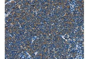 The image on the left is immunohistochemistry of paraffin-embedded Human Lymphoma tissue using ABIN7190319(CNTNAP3 Antibody) at dilution 1/40, on the right is treated with synthetic peptide. (CNTNAP3 antibody)