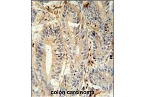MEP1A antibody (N-term) (ABIN652039 and ABIN2840513) immunohistochemistry analysis in formalin fixed and paraffin embedded human colon carcinoma followed by peroxidase conjugation of the secondary antibody and DAB staining.