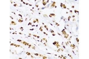 Immunohistochemistry of paraffin-embedded Human breast cancer using DDX39B Polyclonal Antibody at dilution of 1:100 (40x lens).