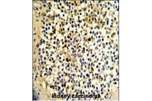 Formalin-fixed and paraffin-embedded human kidney carcinoma with DCXR Antibody (Center), which was peroxidase-conjugated to the secondary antibody, followed by DAB staining. (DCXR antibody  (AA 79-106))