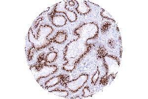 Prostatic adenocarcinoma Gleason 336 with strong granular perinuclear cytoplasmic prostein staining of tumor cells (Recombinant SLC45A3 antibody  (N-Term))