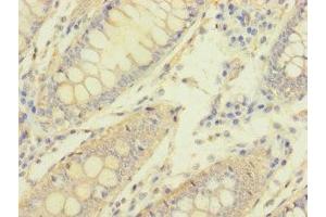 Immunohistochemistry of paraffin-embedded human colon cancer using ABIN7162103 at dilution of 1:100 (MACROD1 antibody  (AA 83-325))