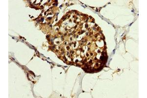 IHC image of ABIN7154867 diluted at 1:200 and staining in paraffin-embedded human breast cancer performed on a Leica BondTM system. (HSP70 1A antibody  (AA 418-512))