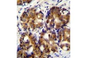 Immunohistochemistry analysis in formalin fixed and paraffin embedded human breast carcinoma reacted with CD168 / HMMR Antibody (C-term) followed by peroxidase conjugation of the secondary antibody and DAB staining.