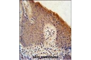 KRT1 Antibody (Center) (ABIN651241 and ABIN2840150) immunohistochemistry analysis in formalin fixed and paraffin embedded human skin carcinoma followed by peroxidase conjugation of the secondary antibody and DAB staining.