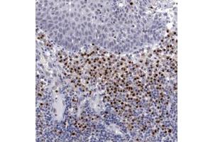 Immunohistochemical staining of human IRF4 polyclonal antibody  shows strong nuclear positivity in lymphoid cells outside reaction centra at 1:250 dilution. (IRF4 antibody)