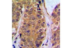 Immunohistochemical analysis of NF-kappaB p105 (pS927) staining in human breast cancer formalin fixed paraffin embedded tissue section.