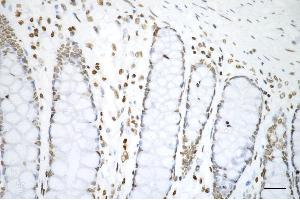 Immunohistochemistry was performed on paraffin-embedded human sigmoid colon carcinoma using histone H3 (di methyl K4) antibody (ABIN7798955), 1:200).