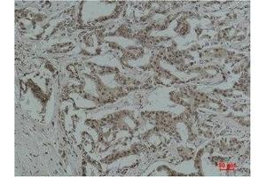 Immunohistochemical analysis of paraffin-embedded Human Breast Carcinoma using Acetyl Lysine Monoclonal Antibody. (Acetylated Lysine antibody)