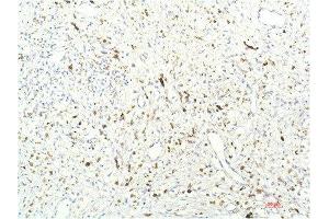 Immunohistochemical analysis of paraffin-embedded Human Breast Carcinoma Tissue using JAK1 Mouse mAb diluted at 1:200. (JAK1 antibody  (AA 960-1040))