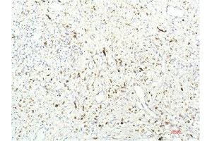 Immunohistochemical analysis of paraffin-embedded Human Breast Carcinoma Tissue using JAK1 Mouse mAb diluted at 1:200.