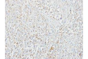 IHC-P Image Immunohistochemical analysis of paraffin-embedded CL1-5 xenograft, using MIPEP, antibody at 1:100 dilution. (MIPEP antibody)