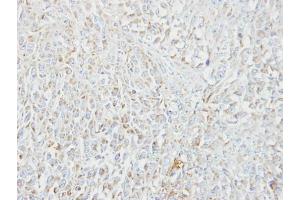 IHC-P Image Immunohistochemical analysis of paraffin-embedded CL1-5 xenograft, using MIPEP, antibody at 1:100 dilution.