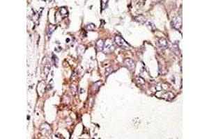 IHC analysis of FFPE human hepatocarcinoma stained with the SUMO4 antibody (SUMO4 antibody)