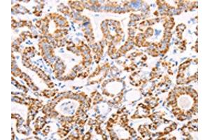 The image on the left is immunohistochemistry of paraffin-embedded Human thyroid cancer tissue using ABIN7128594(ATPIF1 Antibody) at dilution 1/50, on the right is treated with fusion protein. (ATPase Inhibitory Factor 1 antibody)