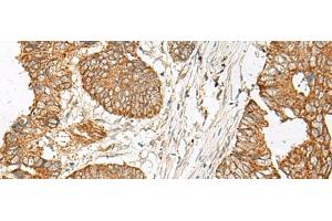 Immunohistochemistry of paraffin-embedded Human colorectal cancer tissue using GNAT1 Polyclonal Antibody at dilution of 1:25(x200) (GNAT1 antibody)
