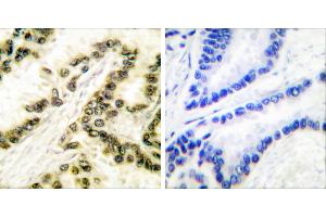 Peptide - +Immunohistochemical analysis of paraffin-embedded human breast carcinoma tissue using AP-2 antibody. (TFAP2A antibody)